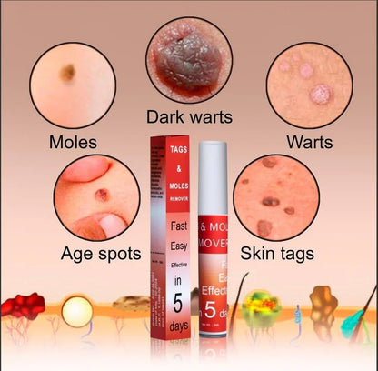 Ayurcare™ tags & mole remover