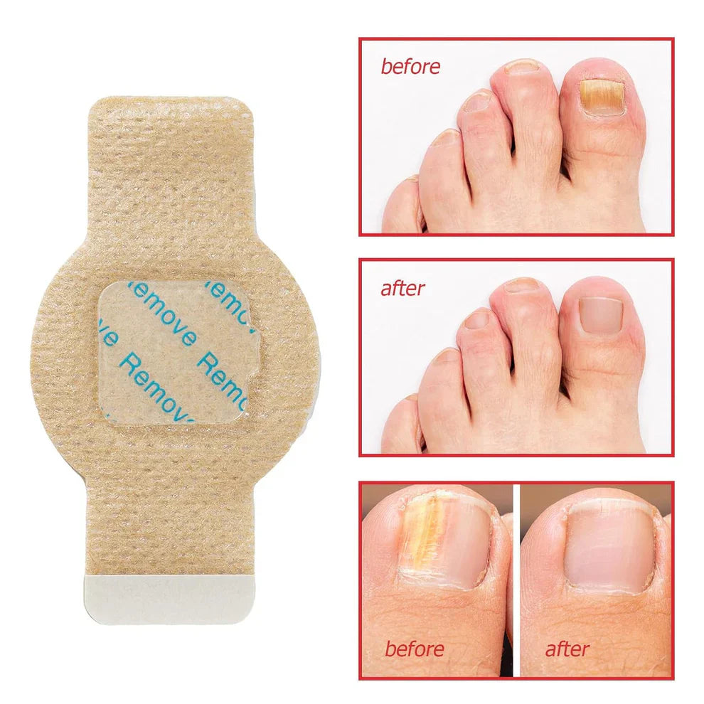 NailHeal Fungal Nail Patches - 7 Day Antifungal Treatment