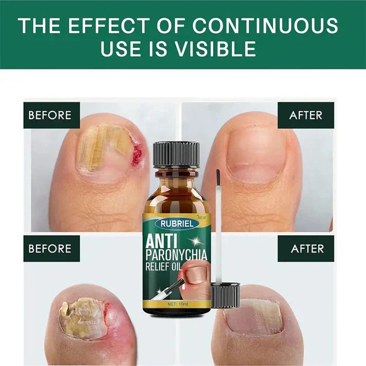 Anti Paronychia Nail Relief Oil - Natural Nail Infection Treatment