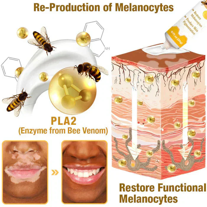 Bee Venom Vitiligo Correcting Cream - Pack of 2