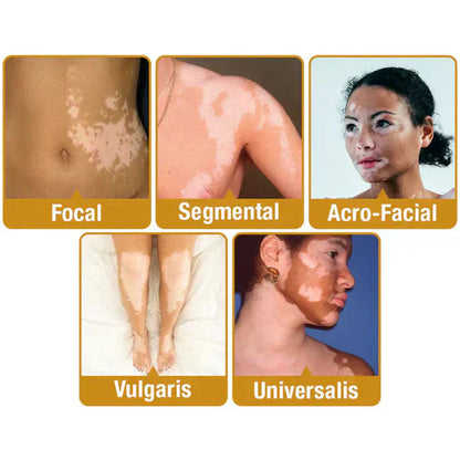 Bee Venom Vitiligo Correcting Cream - Pack of 2